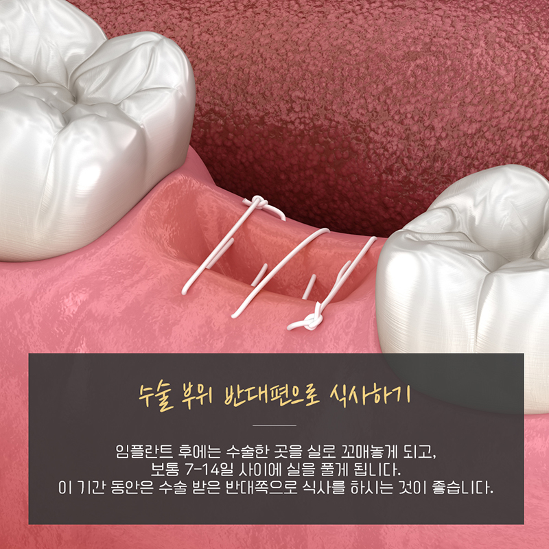 임플란트 후 식사는 어떻게 하나요? 관련 이미지 2