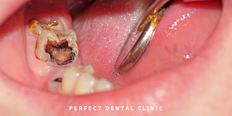 치과 충치치료비용 알고가기! 관련 이미지 1