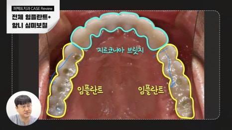 전악 임플란트 비용 궁금하다면 관련 이미지 4