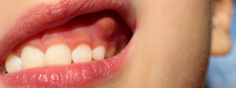 잇몸에 물혹이? 치아낭종 파헤치기! 관련 이미지 2