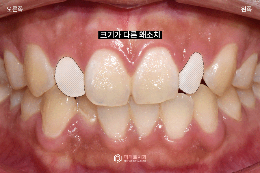 6년 전 라미네이트 교체&연장, 그 이유는?😯 관련 이미지 2