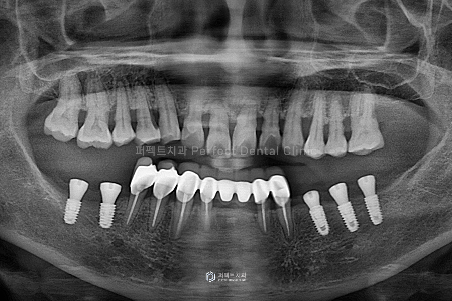 윗니 전체 신경치료 했다고?😱 교합평면이 뭐길래 관련 이미지 4