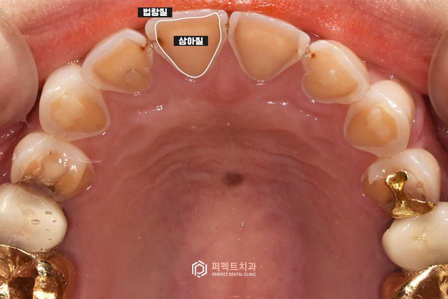 치아도 부식될 수 있다? 치아부식의 원인은? 관련 이미지 2