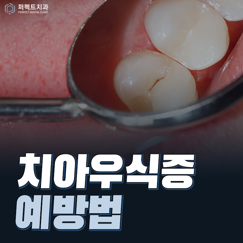 치아우식증 증상과 예방법 관련 이미지 1