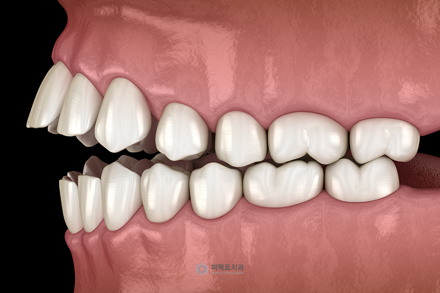 치아교정 미니스크류|꼭 심어야되나요?, 통증은? 관련 이미지 2