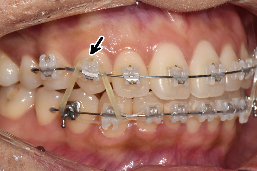 클리피씨를 이용한 부분교정, 얼마나 걸릴까? 관련 이미지 6