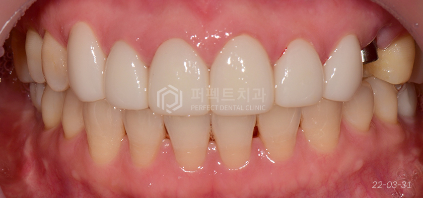 라미네이트를 뜯어보니😨..충격주의 #앞니신경치료 관련 이미지 7