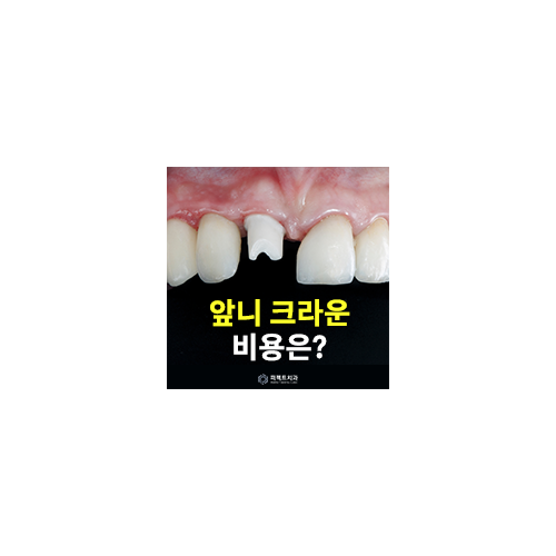 앞니 크라운 종류와 비용 관련 이미지 4