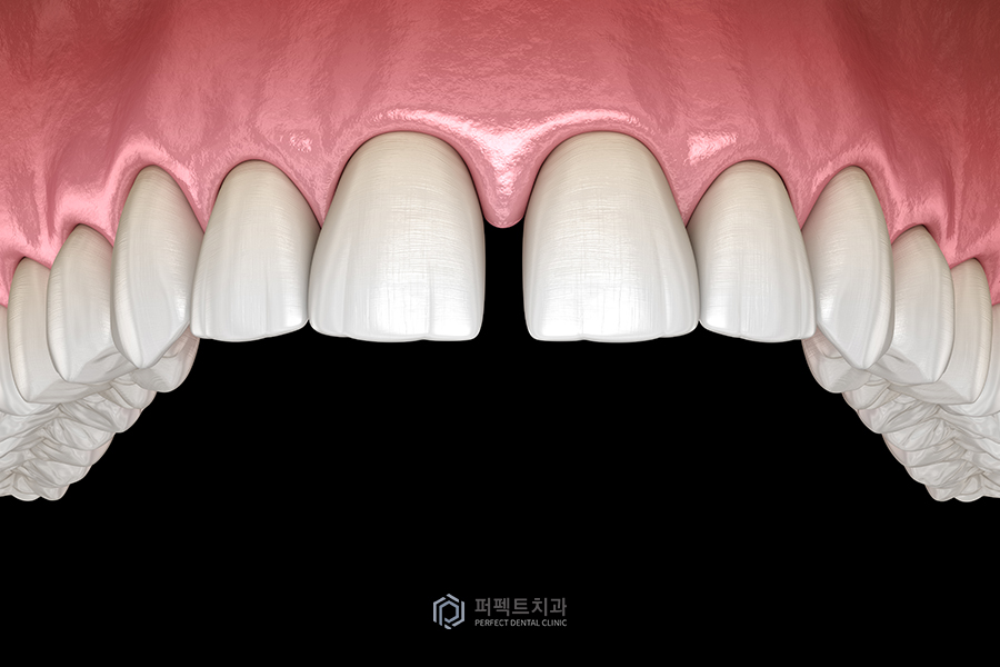 앞니 레진치료의 장단점은? 관련 이미지 1