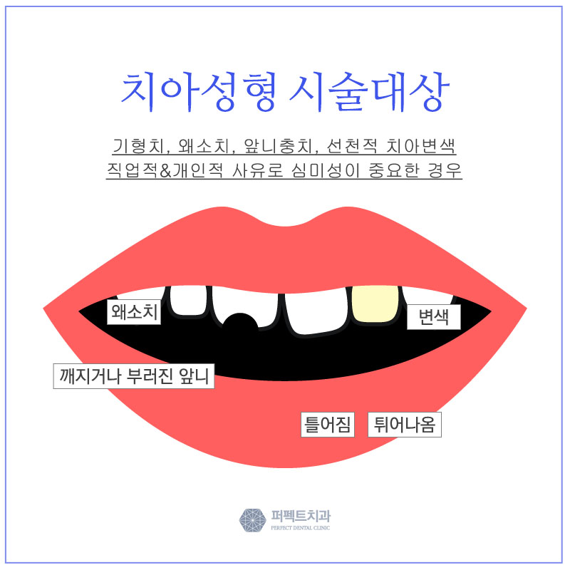 넌 앞니라미네이트 어디서하니? 관련 이미지 2