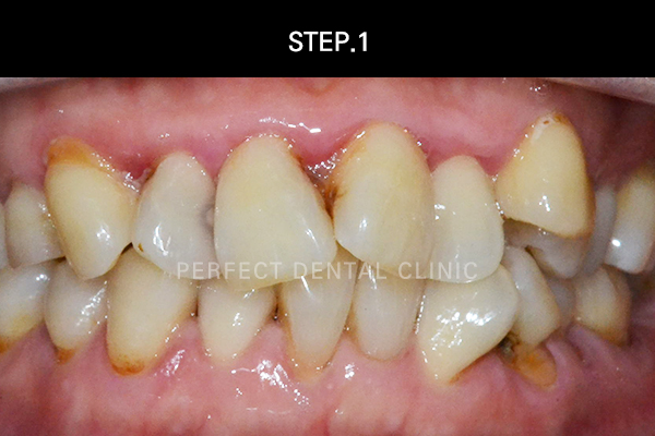 연예인라미네이트후기 관련 이미지 2