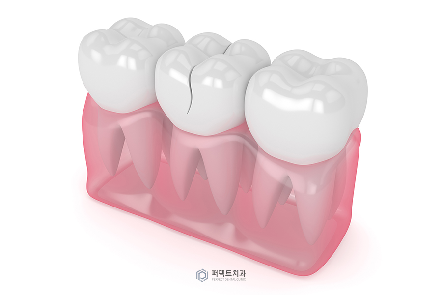 #3 충치치료 후 통증, 혹시 이거 때문에..? 관련 이미지 2