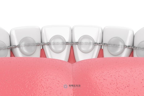 라미네이트 후 치아가 벌어졌어요! 관련 이미지 3