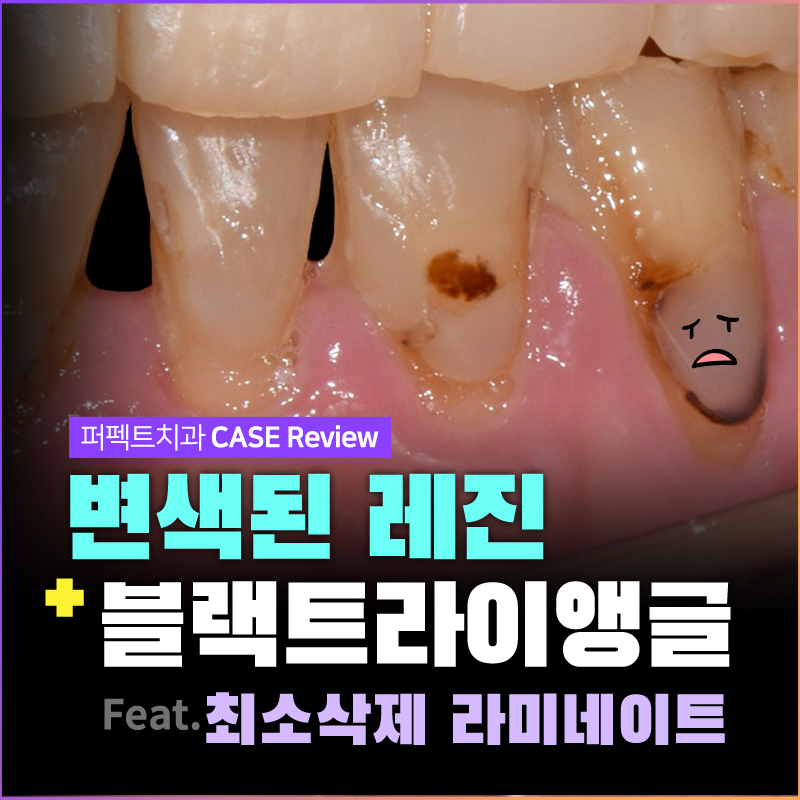 변색된 레진 치료방법 (feat.최소삭제라미네이트) 관련 이미지 1