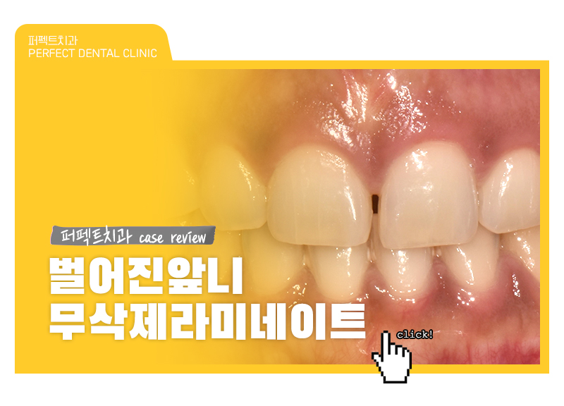 벌어진앞니 무삭제라미네이트 케이스 관련 이미지 1