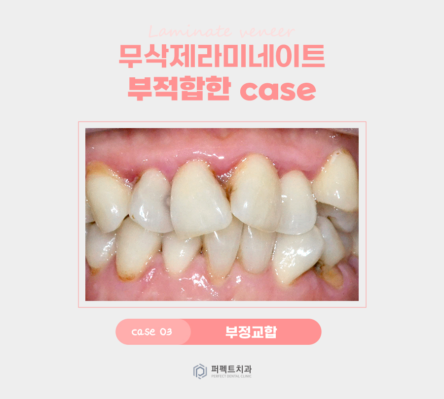 최소삭제, 무삭제 라미네이트가 적합하지 않은 경우는? 관련 이미지 4