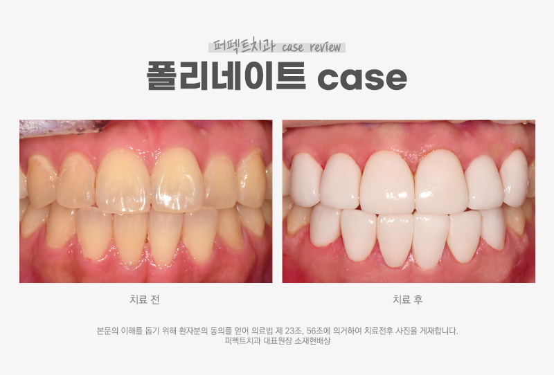 앞니 폴리네이트+치아미백 치료 관련 이미지 9