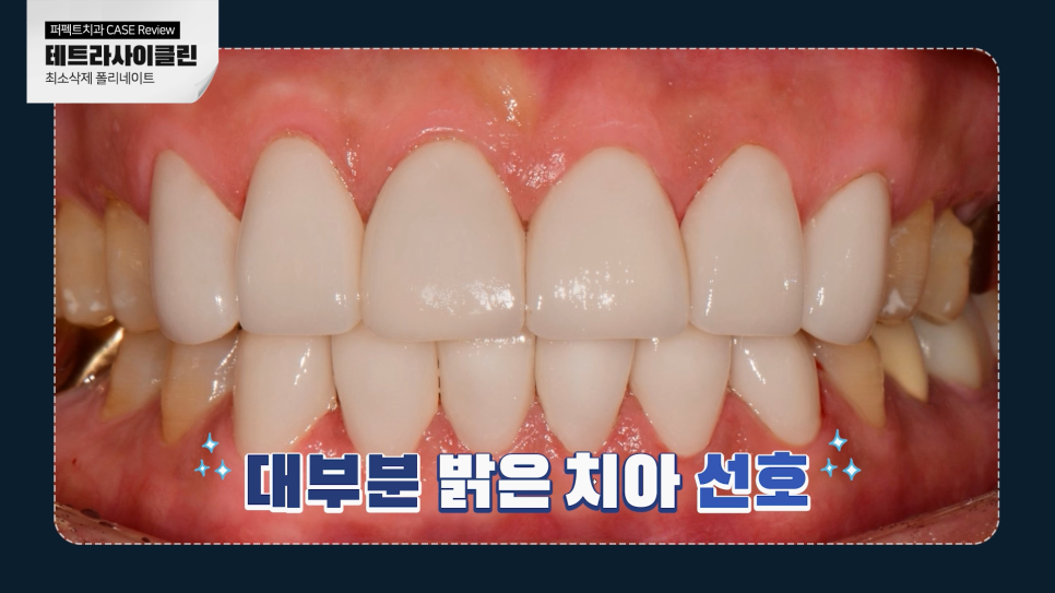 줄무늬 치아 테트라사이클린, 라미네이트vs치아미백 어떤 치료? 관련 이미지 5