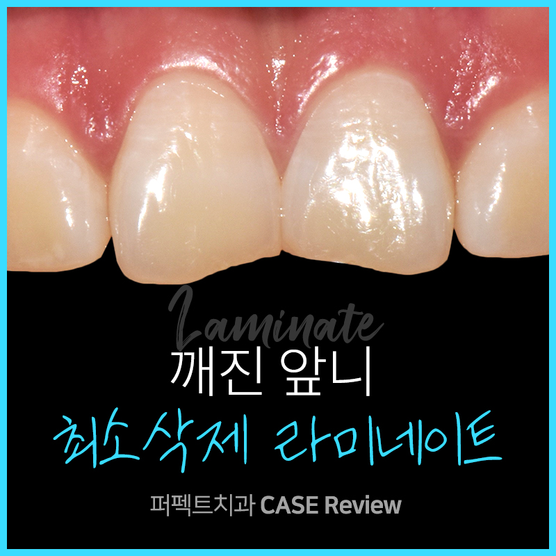 깨진 앞니 치료, 라미네이트로! 관련 이미지 1