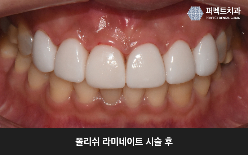앞니 라미네이트 치아삭제량 확인해보세요! 관련 이미지 6