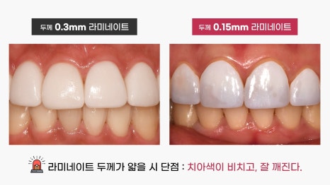 앞니 라미네이트 가격과 두께의 진실 관련 이미지 4