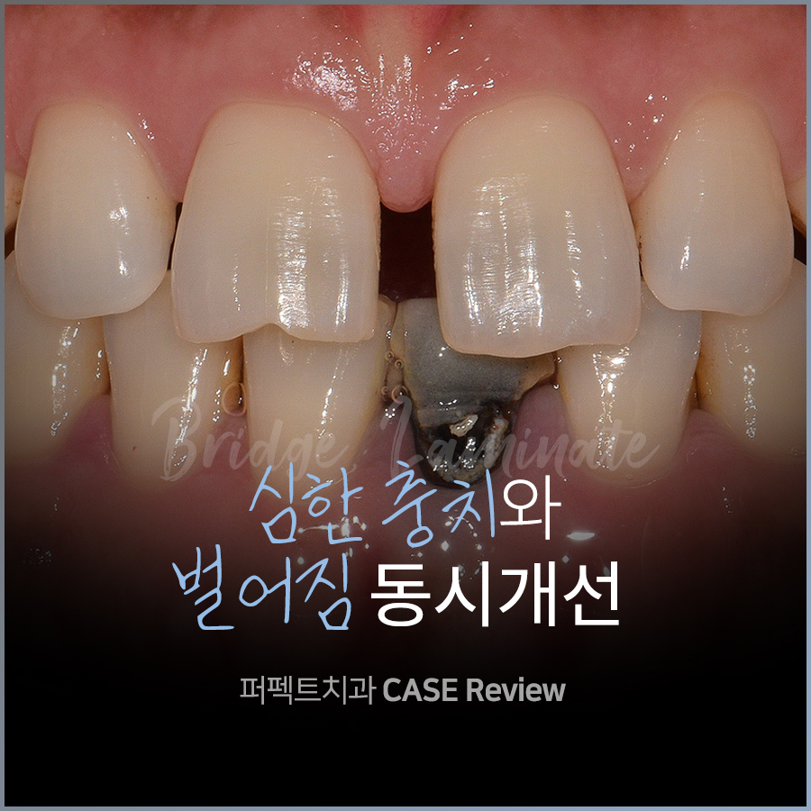 앞니충치, 벌어짐 동시에 치료하는 방법 관련 이미지 1