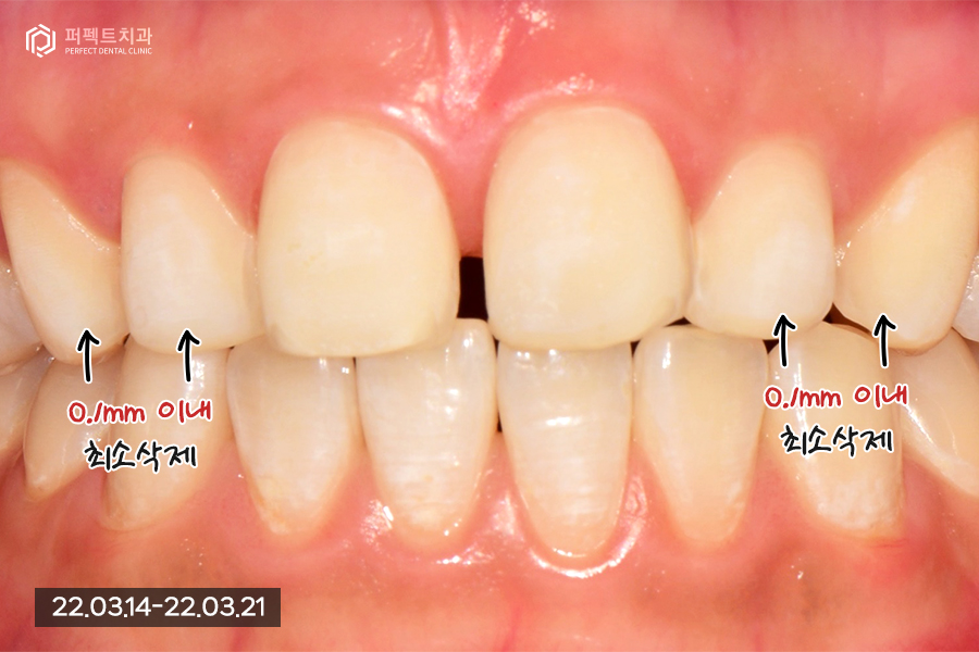 앞니 돌출 있는데 폴리네이트로 극복 가능..?🤔 관련 이미지 6