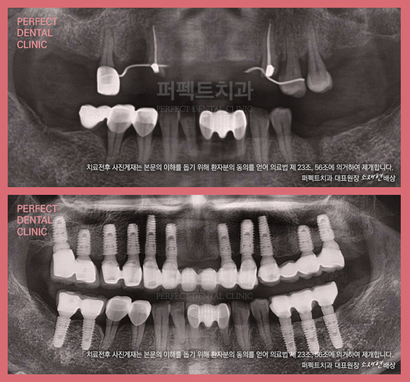 치주질환 방심한 20대, 임플란트 해야하는 이유 관련 이미지 2