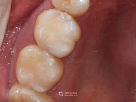 충치치료 인레이, 어떤 경우에? 관련 이미지 7