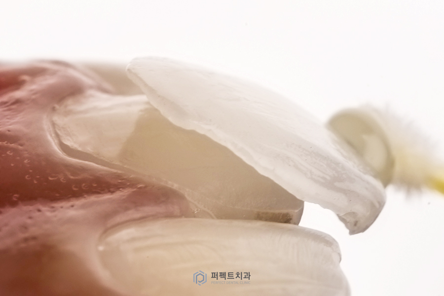 라미네이트 시 치과 선택의 기준은? 관련 이미지 4