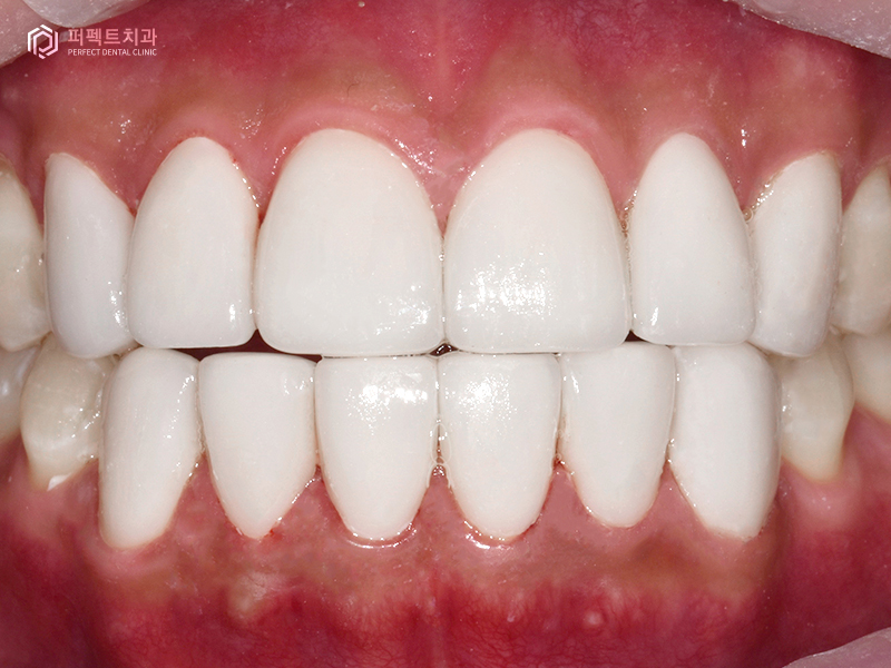 남자라미네이트, 폴리네이트 두가지 케이스 관련 이미지 6