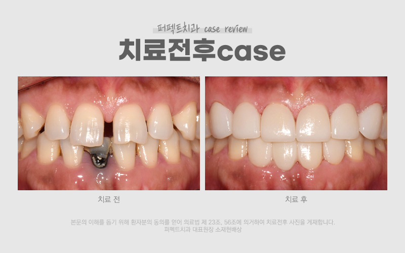 충치+벌어진앞니 라미네이트 case 관련 이미지 7