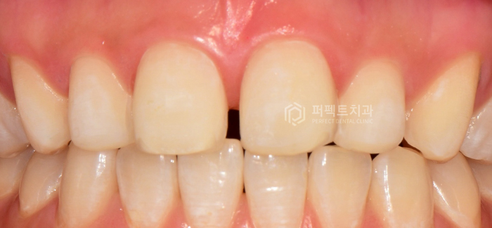 앞니 돌출,벌어짐,변색.. 교정이 싫다면 이 방법으로!? 관련 이미지 7