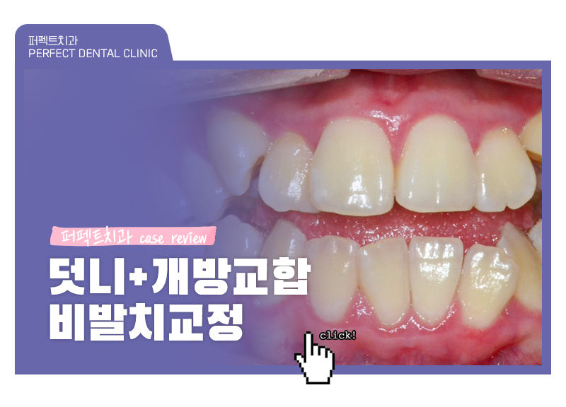 덧니+개방교합, MARPE를 이용한 비발치교정 관련 이미지 1