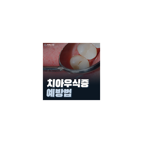 치아우식증 증상과 예방법 관련 이미지 5