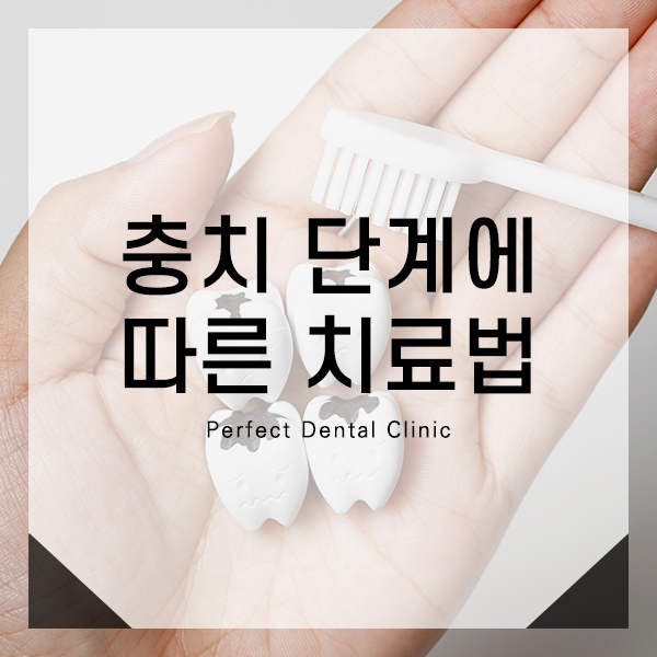 충치 단계에 따른 치료법 관련 이미지 1