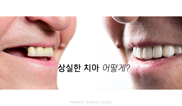 상실한 치아 어떻게 해야하나? 관련 이미지 1