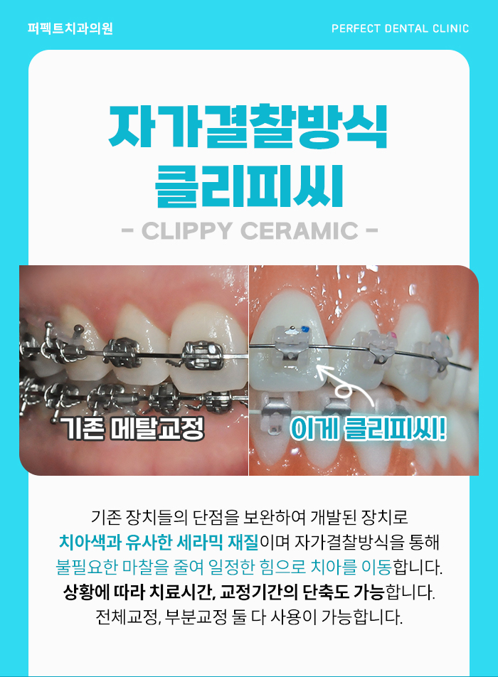 치아교정, 치료 시 참고사항은? 관련 이미지 9