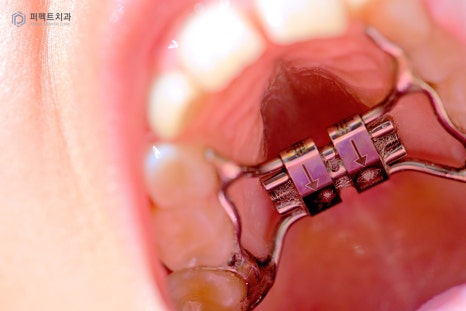 악궁확장장치 MARPE, 사용하는 이유는? 관련 이미지 6