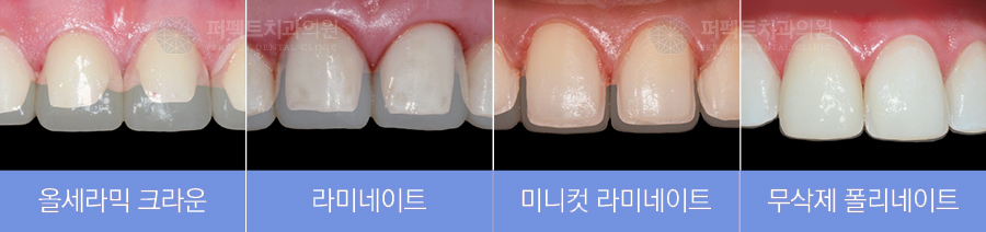 앞니라미네이트 치료,  진짜 이 가격에? 관련 이미지 2