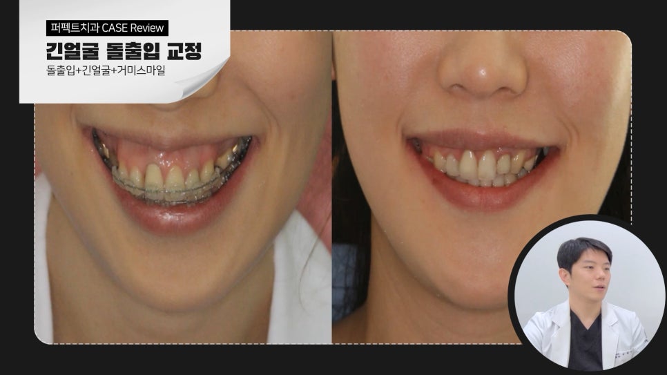긴얼굴+돌출입+거미스마일 비수술교정case 관련 이미지 6