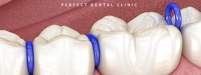 강남역치과 치아부분교정 비용 관련 이미지 3