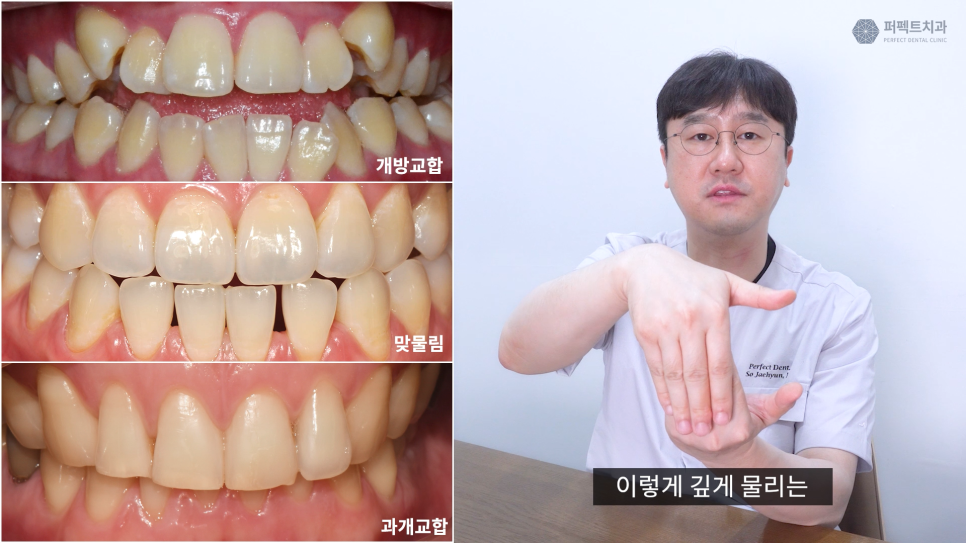 왜소치와 개방교합 문제를 한 번에 개선하다. 관련 이미지 3