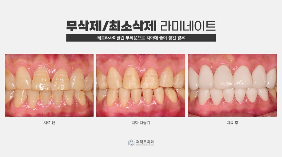 무삭제 라미네이트 추천 및 가능한 케이스 확인하기 관련 이미지 4