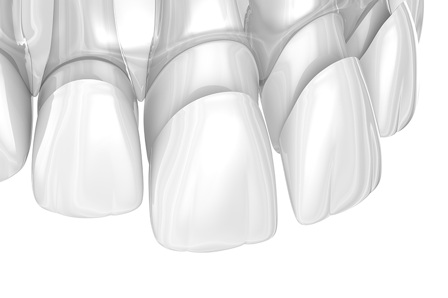 앞니 반점치, 치료 할 수 있는 방법은? 관련 이미지 3