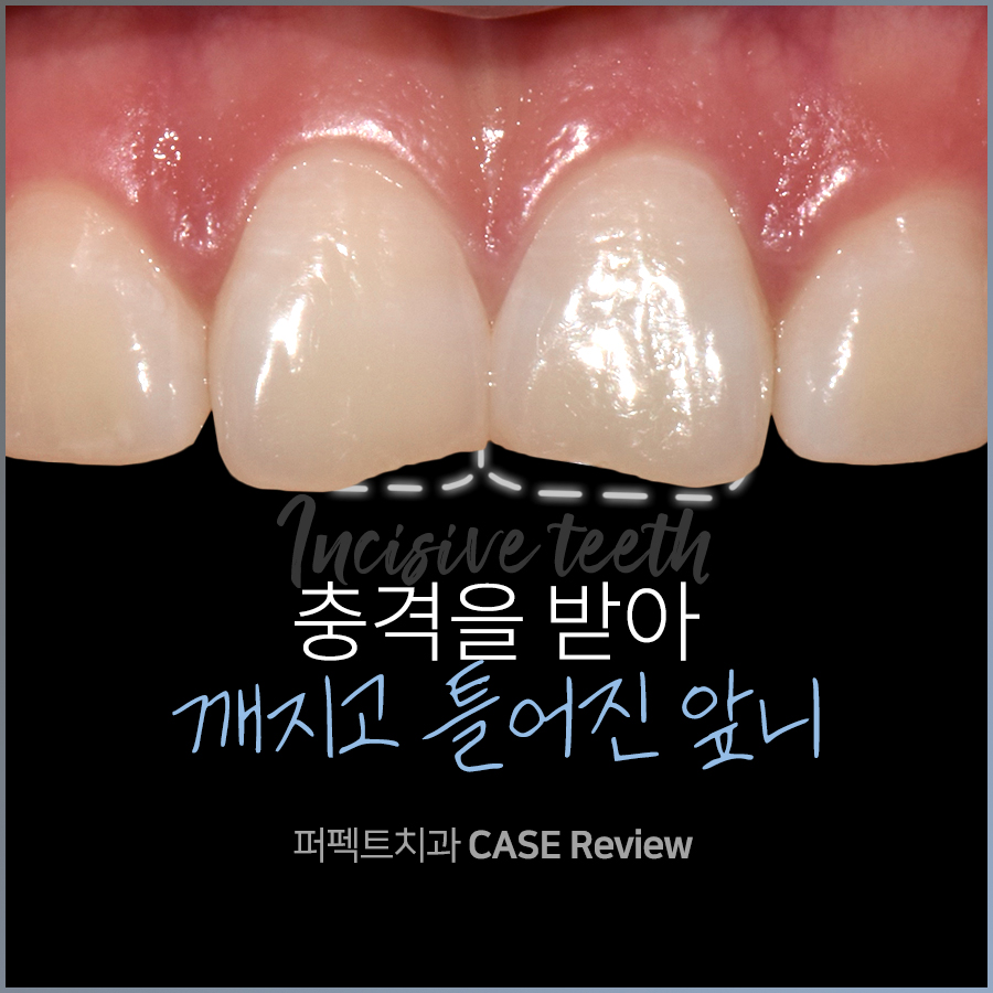틀어진 앞니 깨졌을 때, 최소삭제라미네이트로 개선? 관련 이미지 1