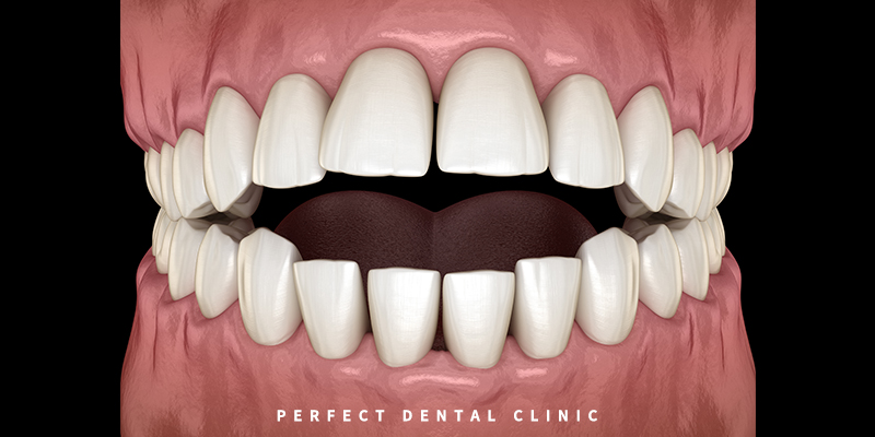 개방교합 치아교정 결과는? 관련 이미지 1