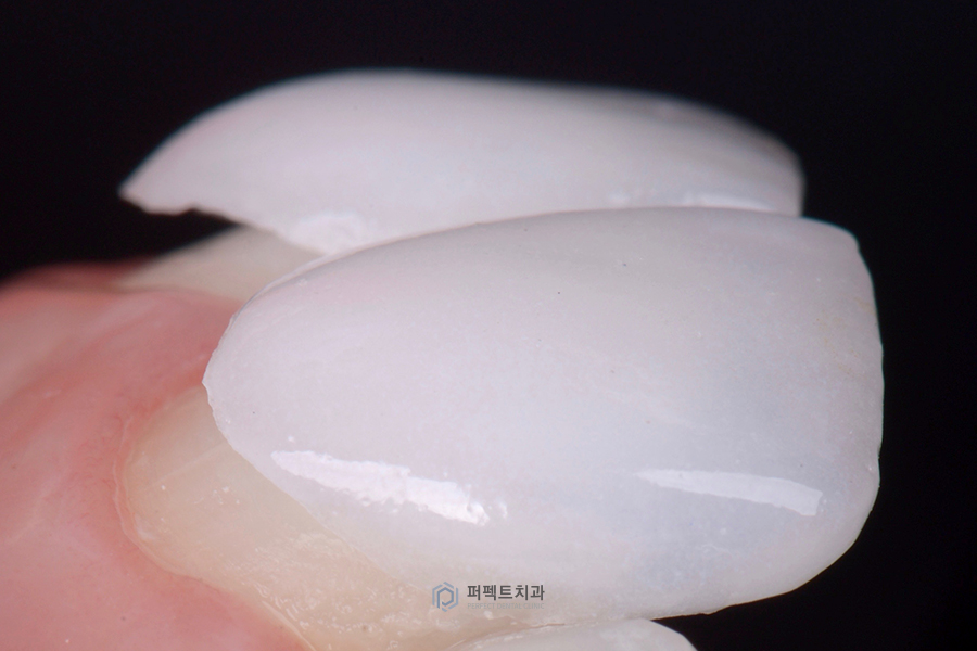 치아에 줄이 있다? 테트라사이클린이란? 관련 이미지 1