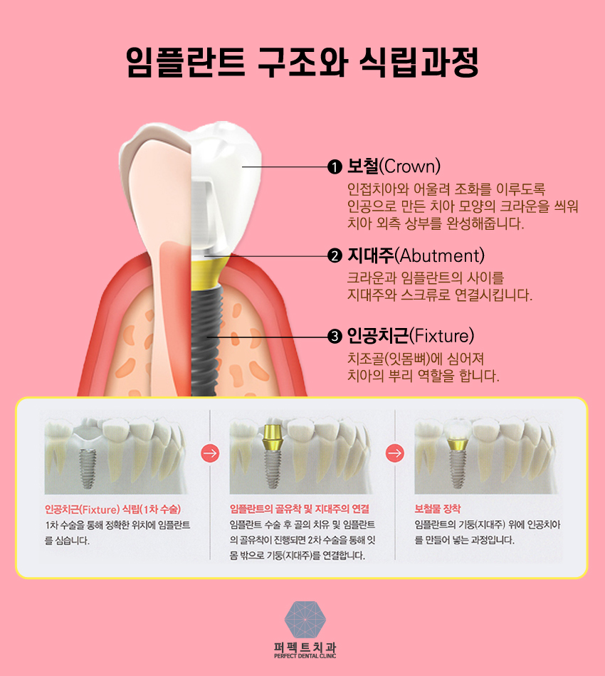 뼈이식임플란트란 뭘까? 관련 이미지 3