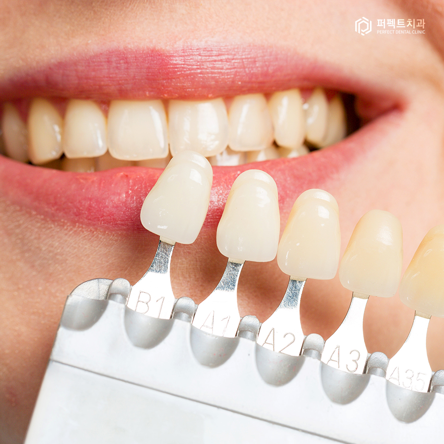 라미네이트와 치아미백 중 어떤 것을 먼저 해야할까요? 관련 이미지 2